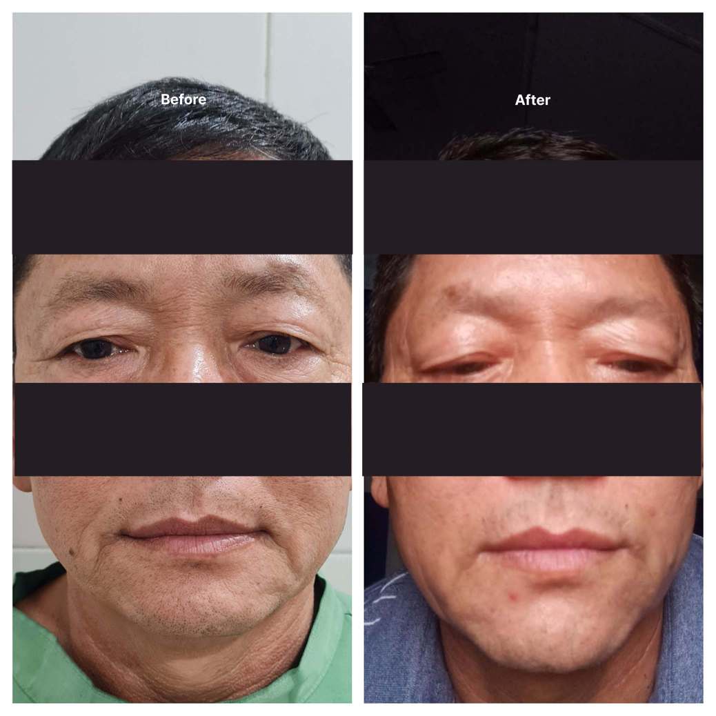 Eyelid Surgery KOQ10